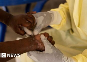 First case of more dangerous mpox found outside Africa